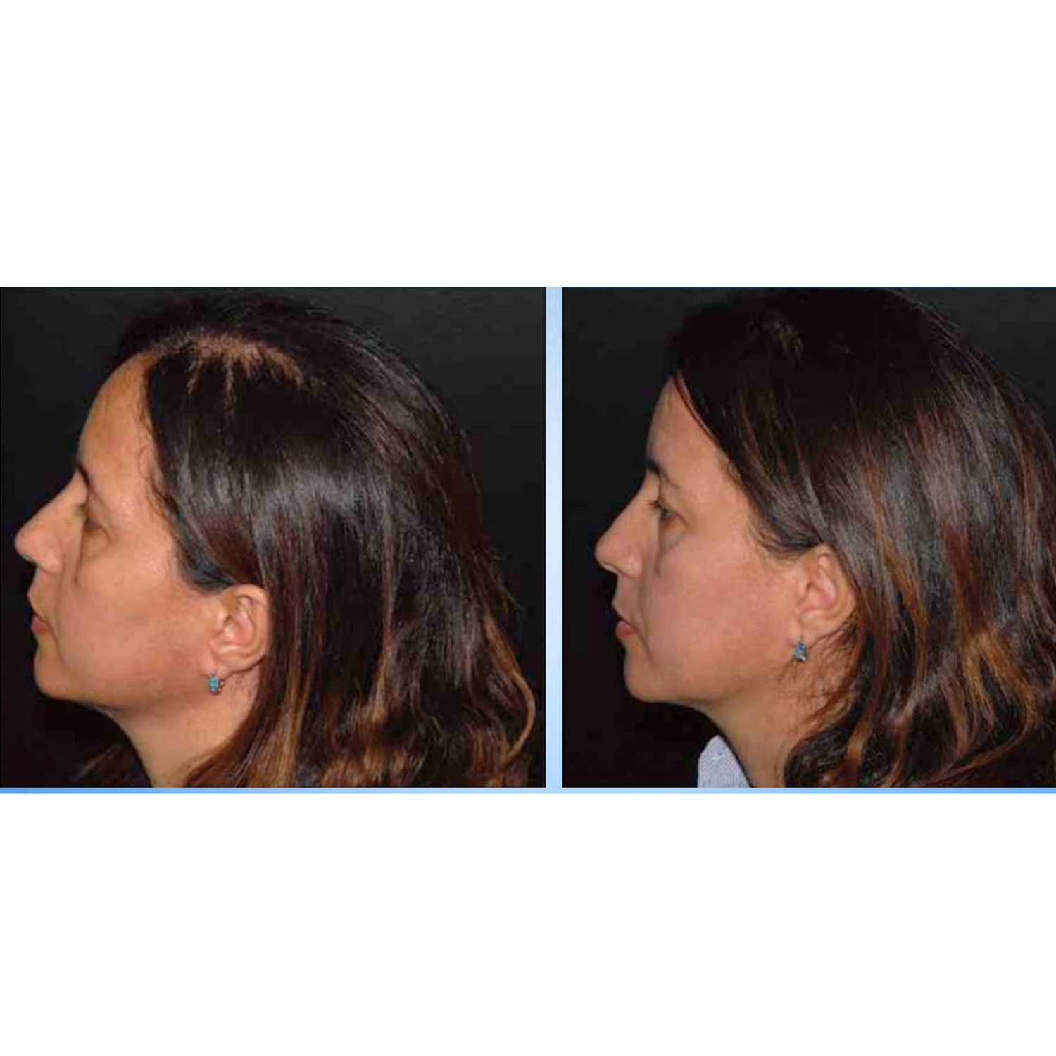 Menopause Hair Thinning — A Physician's Guide to Mechanism, Pattern & Drug-Free Recovery