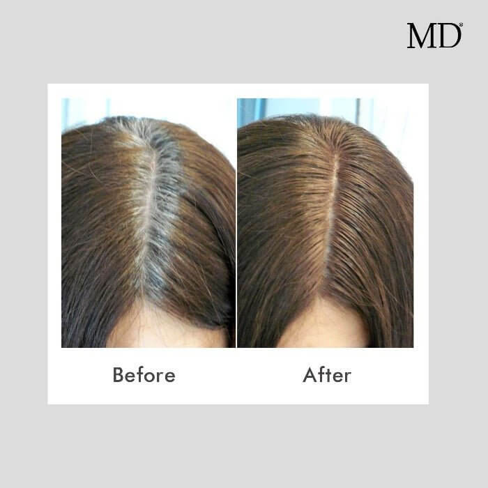 MD Hair Color Restoration For Men and Women - Restore Natural Hair Color- 1.7 fl. oz 30 Days Supply - MD
