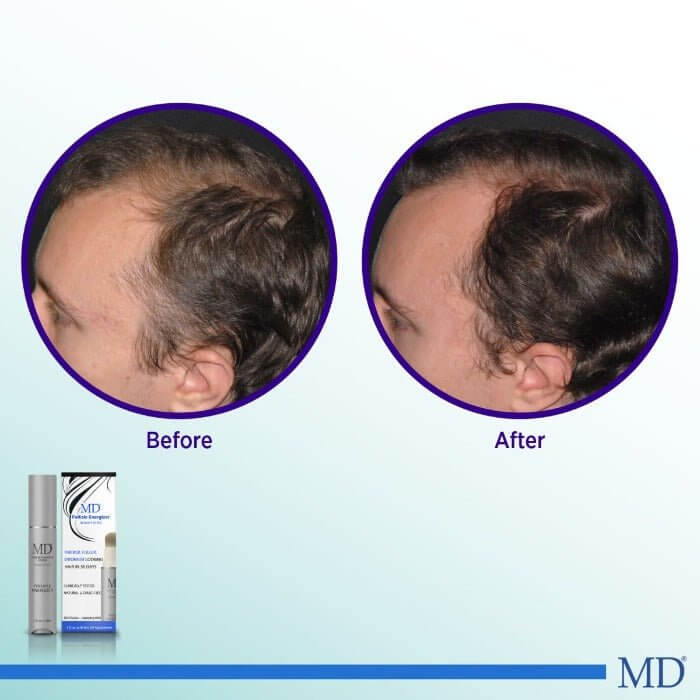 Before and after photo showing visibly thicker, fuller hair after 3 months of using MD Hair – supports regrowth and reduced thinning