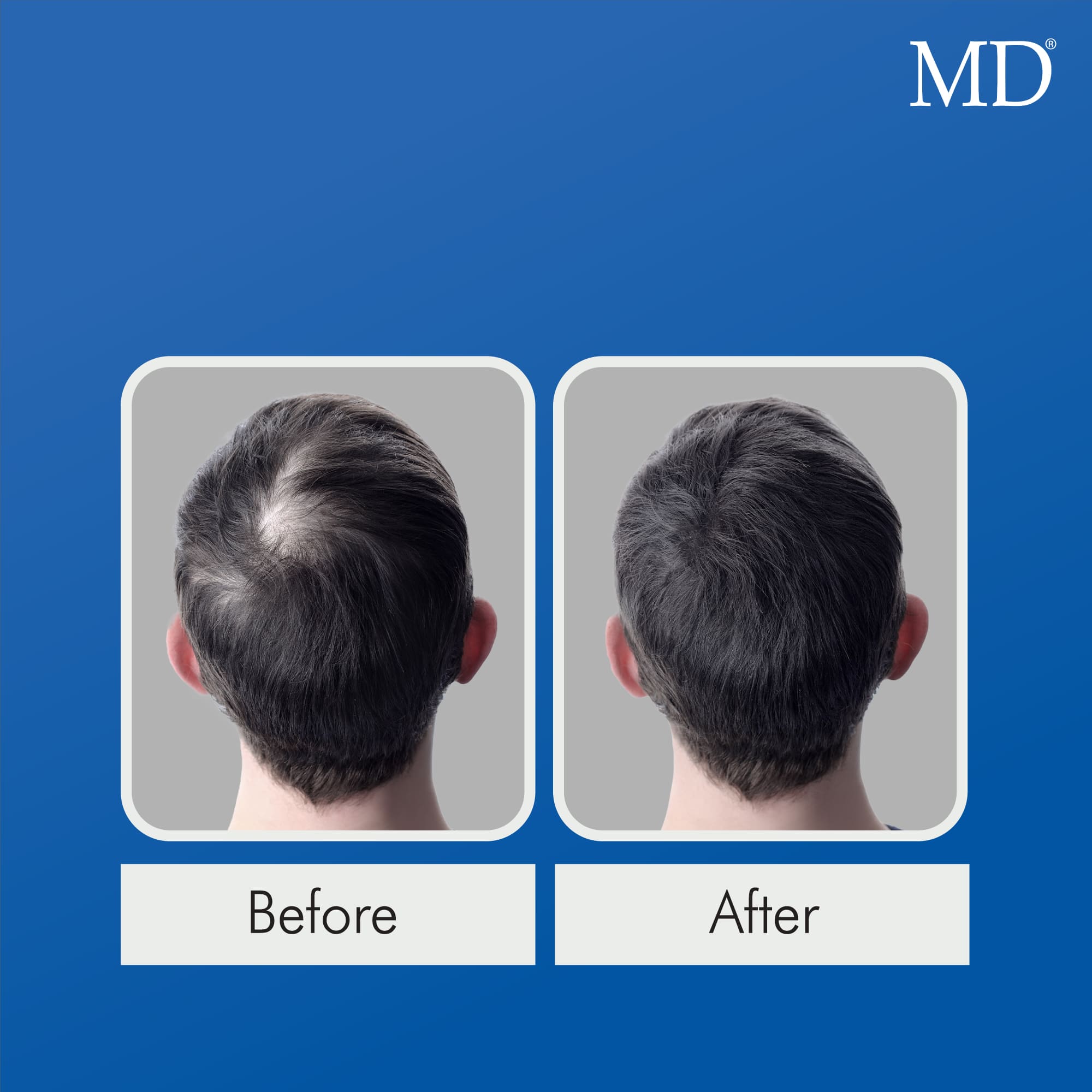 Before and after photo showing visible improvement of bald spot on back of man's scalp after using MD Follicle Energizer – hair regrowth serum from MD Hair