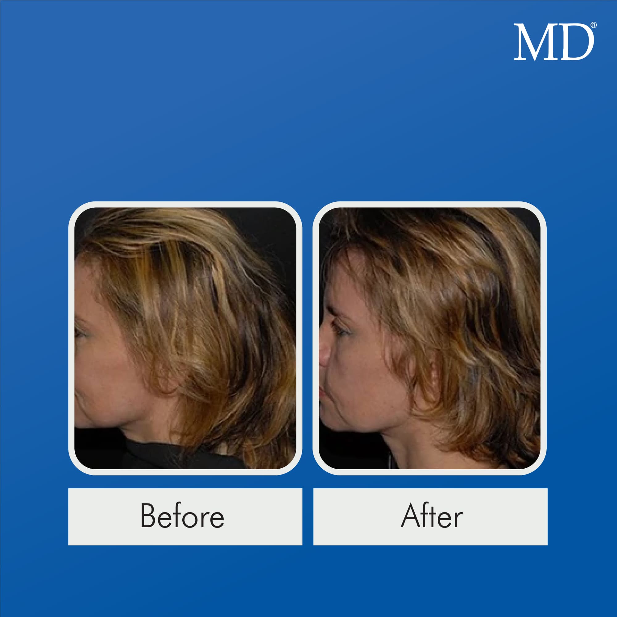 Before and after photo of female user showing visible hair regrowth, thicker and fuller coverage at thinning areas after using MD Follicle Energizer – hair growth serum from the MD Hair system