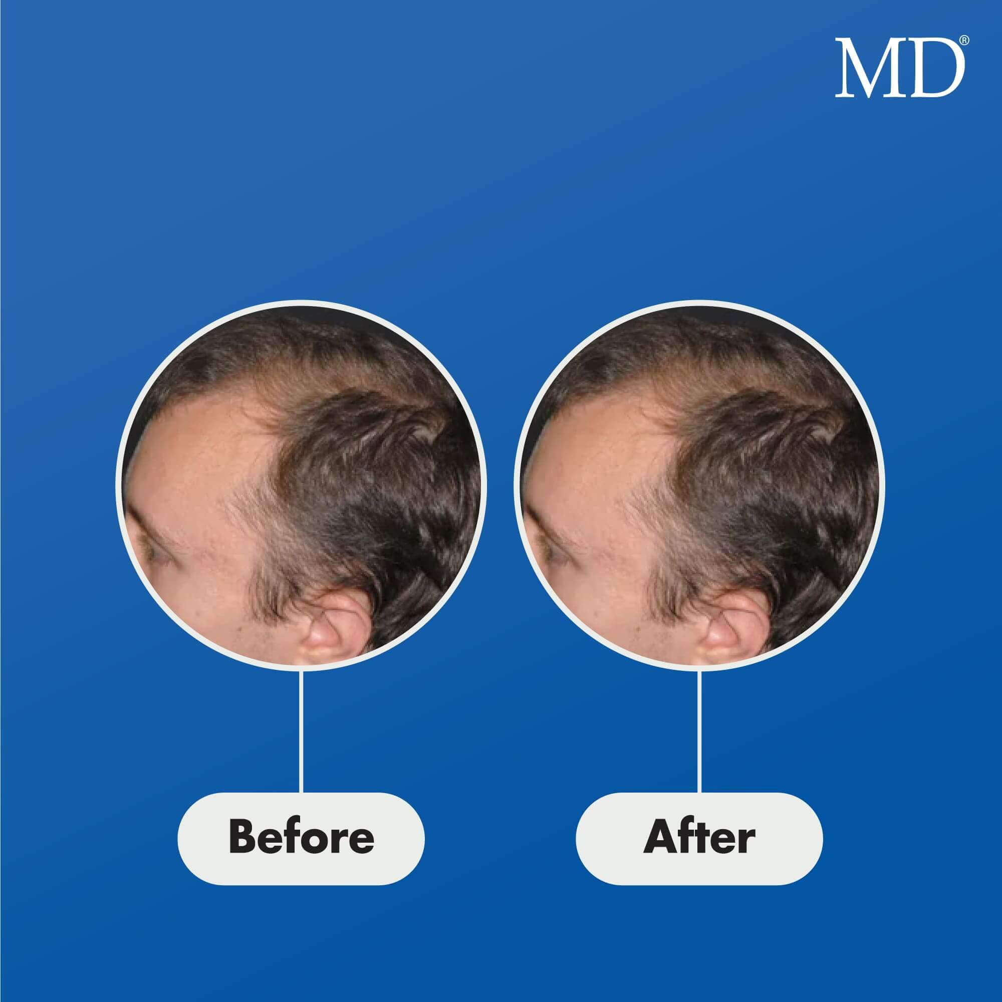 Photo of young male user showing significant hair regrowth and thicker, fuller hair after using MD Follicle Energizer – drug-free serum for thinning hair from the MD Hair system