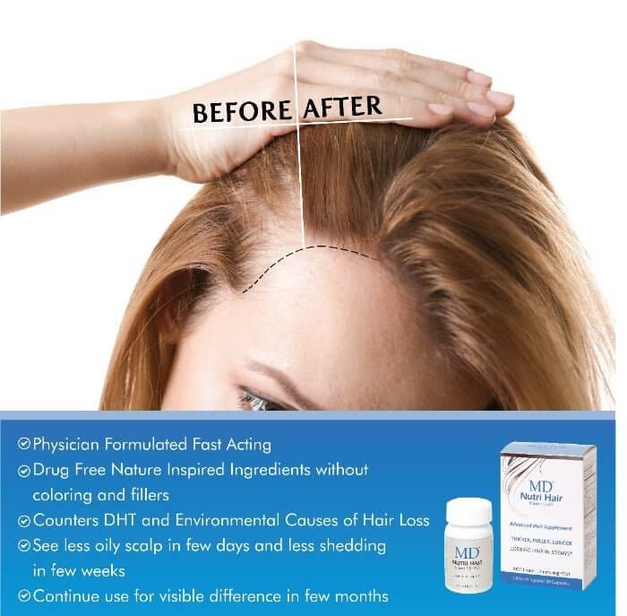 MD Nutri Hair before and after – see less oily scalp in days and reduced shedding in weeks; fast-acting, drug-free, physician-formulated DHT blocker
