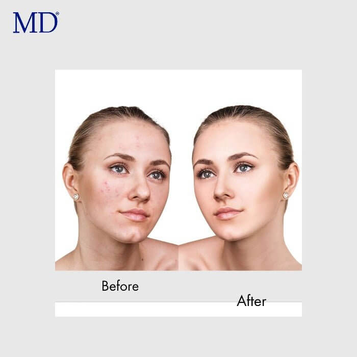 MD White Factor before and after – visibly clearer complexion with reduced breakouts and brighter, healthier-looking skin