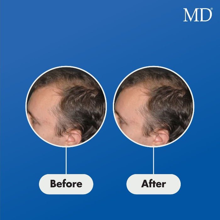 MD® Follicle Energizer Serum - Natural Hair Growth Serum - 30-Day Supply - MD
