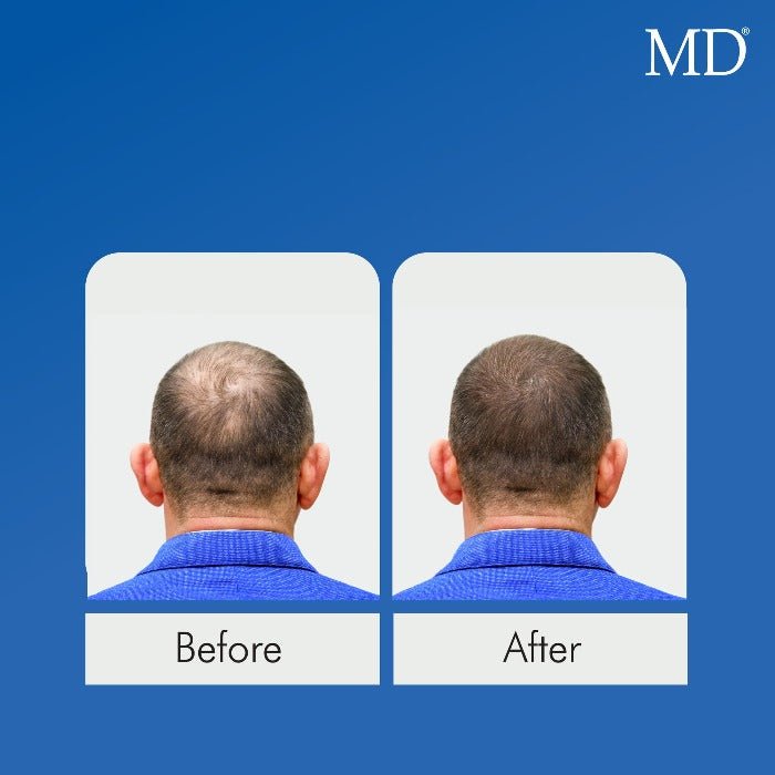 MD Nutri Hair Growth Supplement - Minimizes Hair Shedding, Thinning and Breakage  - 30 Capsules - MD