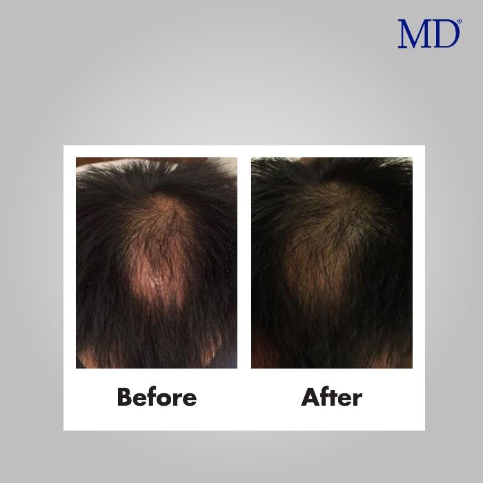 MD® Scalp Essential Anti-Itch Scalp Serum - Thinning and hair loss Treatment  60ml, 2 Months Supply - MD