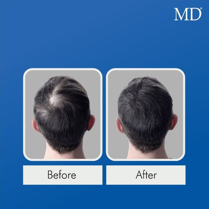 MD® Follicle Energizer Serum - Natural Hair Growth Serum - 30-Day Supply - MD