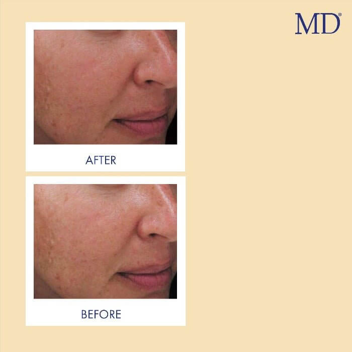 MD Factor Vitamin C Face Serum - Anti-Aging Face Serum with Vitamin C  - 1 fl oz e/ 30ml - MD