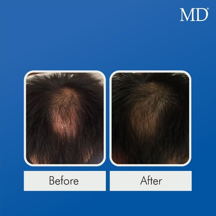 MD® Follicle Energizer Serum - Natural Hair Growth Serum - 30-Day Supply - MD