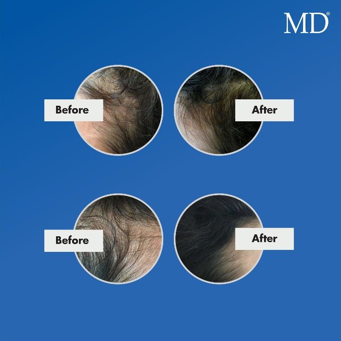MD Nutri Hair Growth Supplement - Minimizes Hair Shedding, Thinning and Breakage  - 30 Capsules - MD