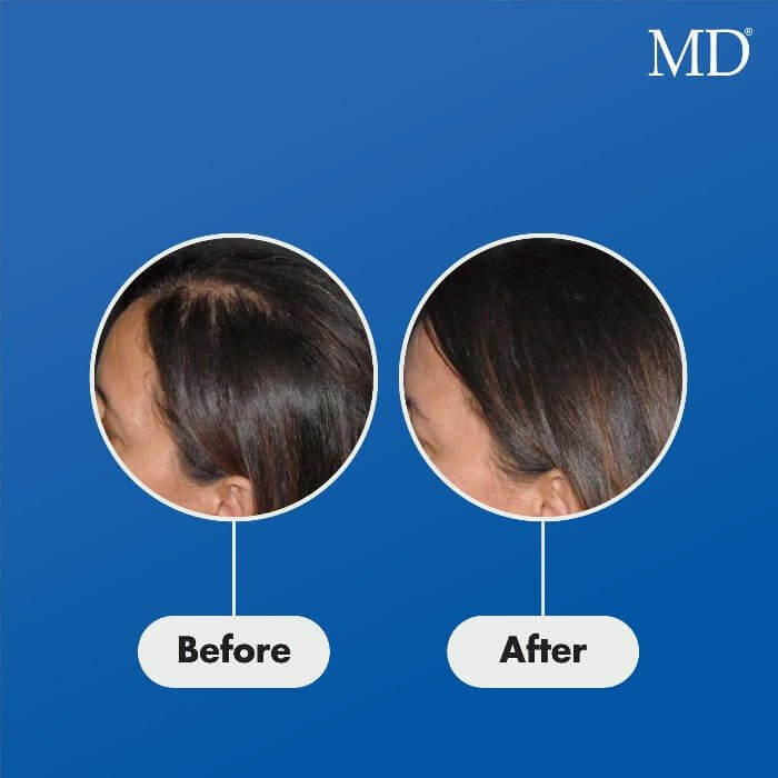 Before and after using MD® Follicle Energizer – visible improvement in hair density and reduced thinning at the crown and temples in female user, part of MD Hair system

