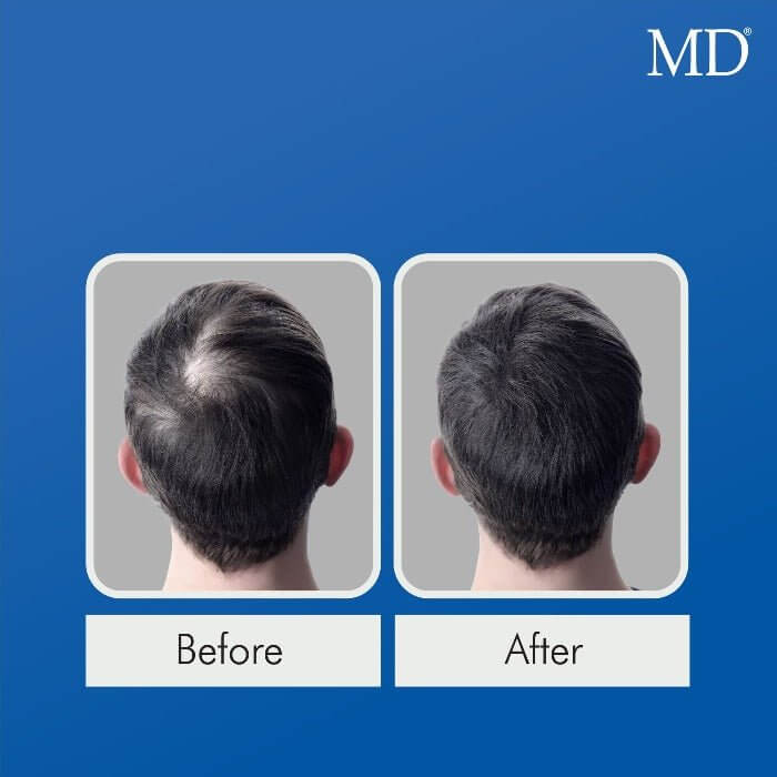 Before and after using MD® Follicle Energizer – visible improvement in bald spot at the back of the scalp in male user, part of the MD Hair system

