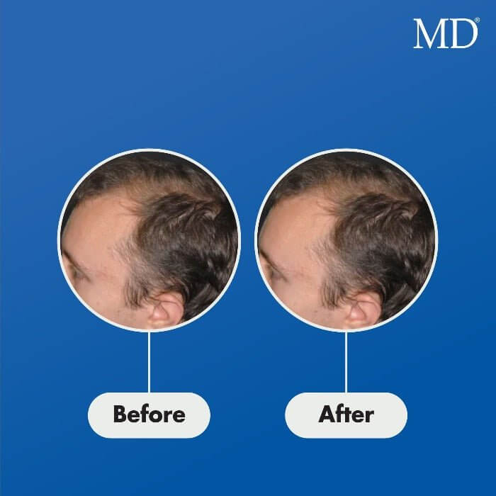 Before and after using MD® Follicle Energizer – visible improvement in hair density and reduced thinning at the crown and temples in male user, part of MD Hair system

