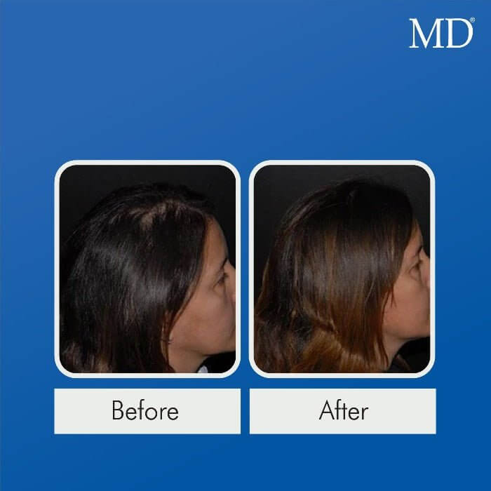Before and after using MD® Follicle Energizer – improved fullness and reduced shedding at hairline and part line in female user, from the MD Hair collection

