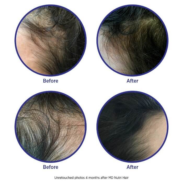 Before and after photo showing hairline regrowth after 4 months using MD Hair – supports fuller, thicker hair and reduced thinning

