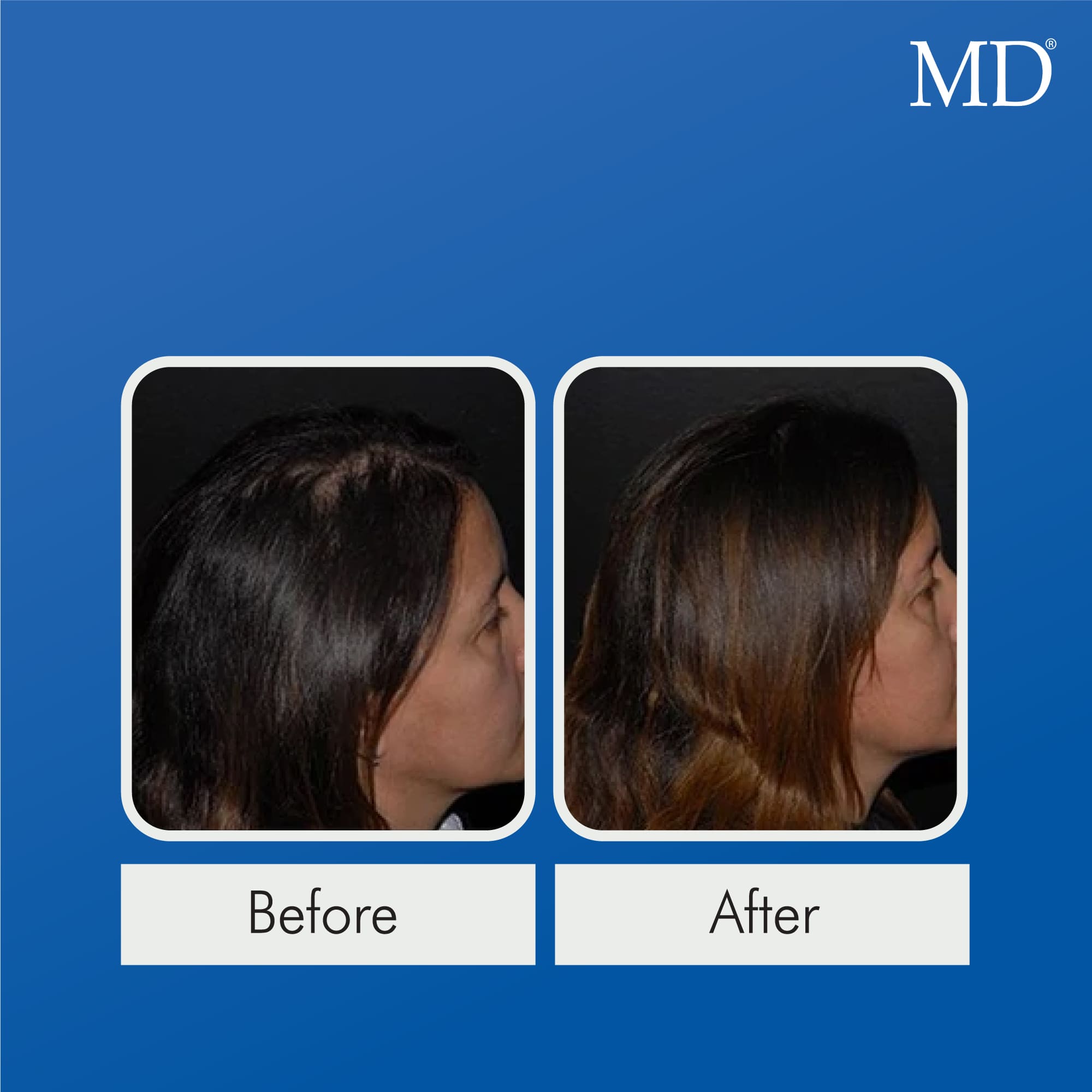 Before and after clinical photo of female user showing visible improvement in bald spots and fuller hair coverage on top of scalp after using MD Follicle Energizer – drug-free hair regrowth serum from the MD Hair system