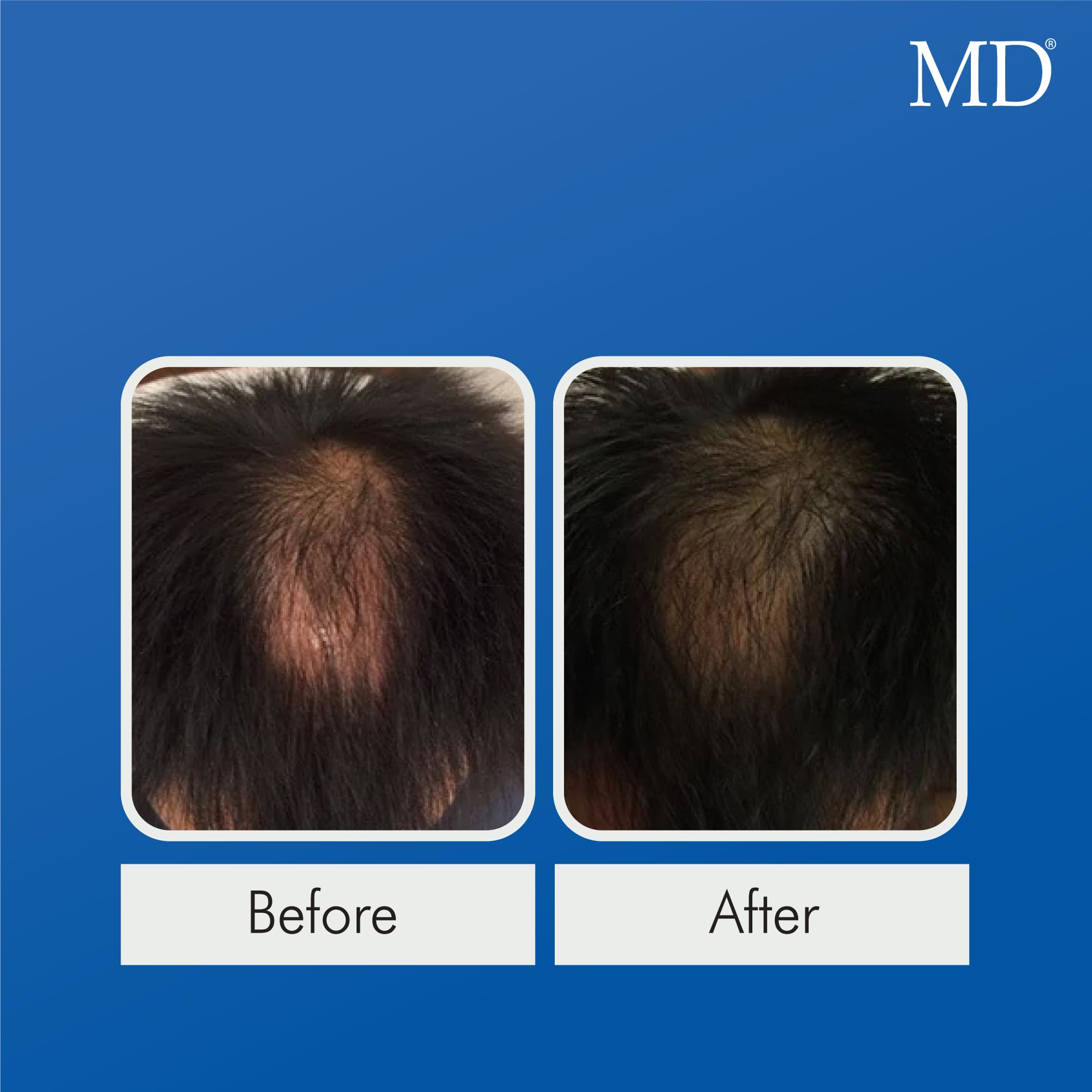 Before and after photo of male user showing visible hair regrowth on large thinning area at top of scalp after using MD Follicle Energizer – part of the MD Hair system for men with advanced hair loss