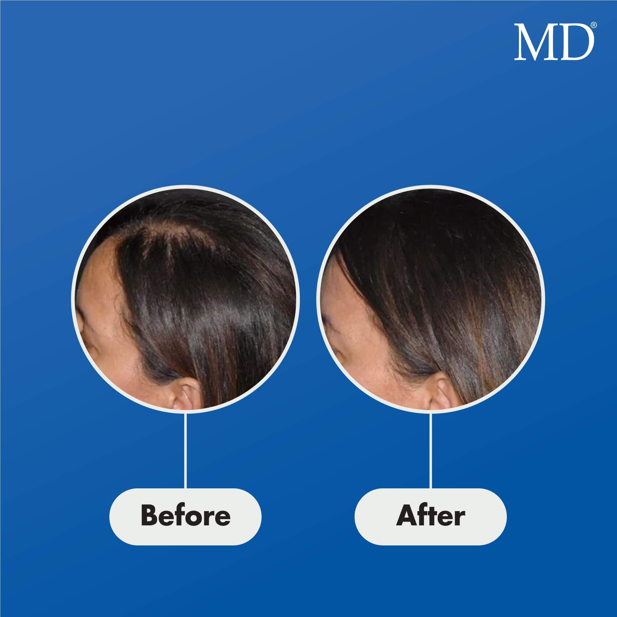 Photo of female user showing visible improvement in hair thickness and fullness after using MD Follicle Energizer – drug-free hair growth serum from the MD Hair system
