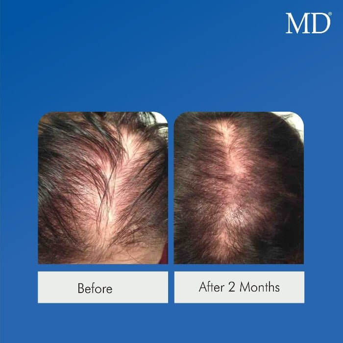 Actual female user after 8 weeks of using MD Nutri Hair showing visibly fuller, thicker hair – real results from drug-free hair growth supplement by MD Hair