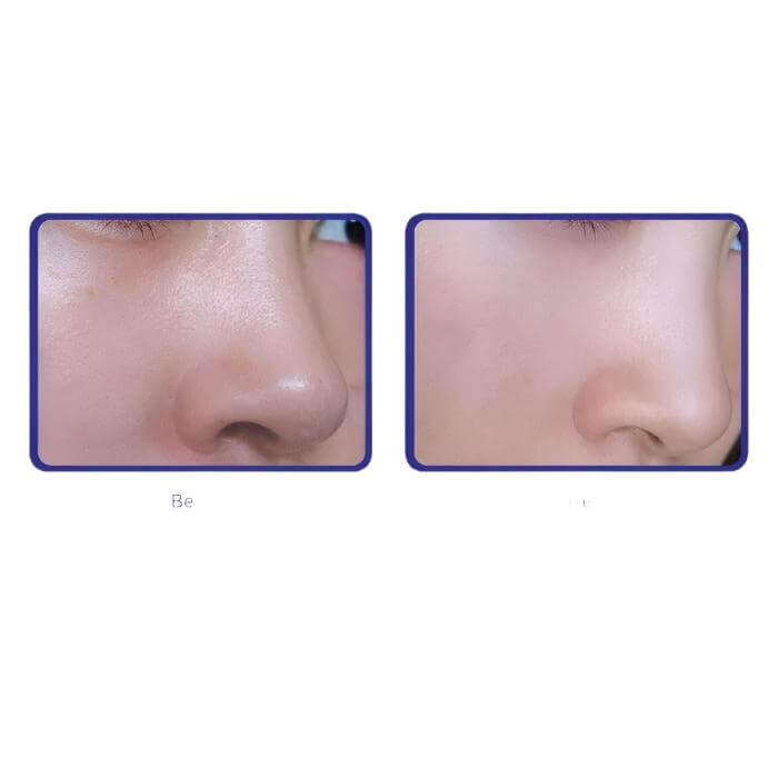 Before and after using MD Ultimate Vitamin C showing visibly clearer skin, smaller pores, and smoother texture for a radiant complexion


